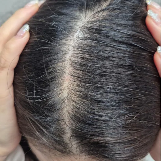 CeraXosome scalp program clinical case, woman aged 45, 5 sessions — after 10 weeks