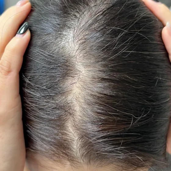 CeraXosome scalp program clinical case, woman aged 45, 5 sessions — baseline