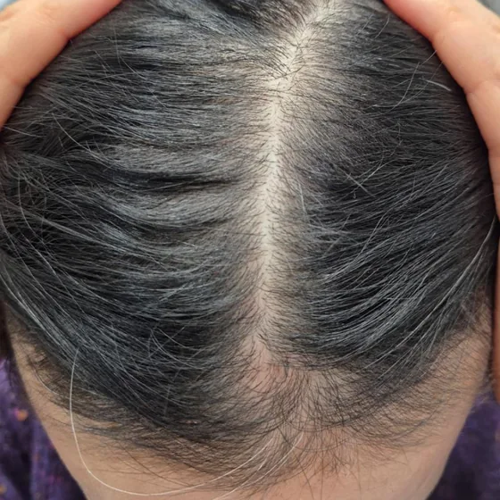 CeraXosome scalp program clinical case, woman aged 52, 7 sessions — after 15 weeks