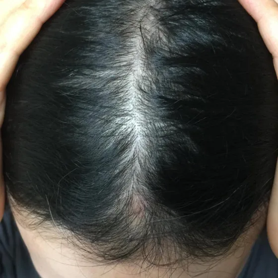CeraXosome scalp program clinical case, woman aged 52, 7 sessions — baseline