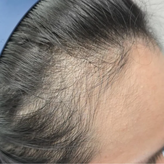 CeraXosome scalp program clinical case, woman aged 32, 5 sessions — after 10 weeks