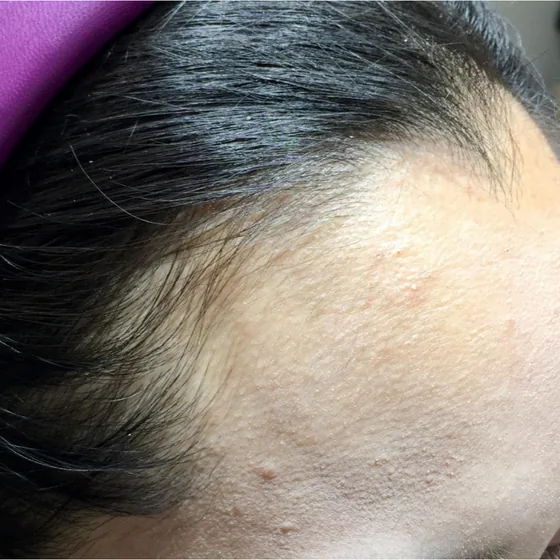CeraXosome scalp program clinical case, woman aged 32, 5 sessions — baseline