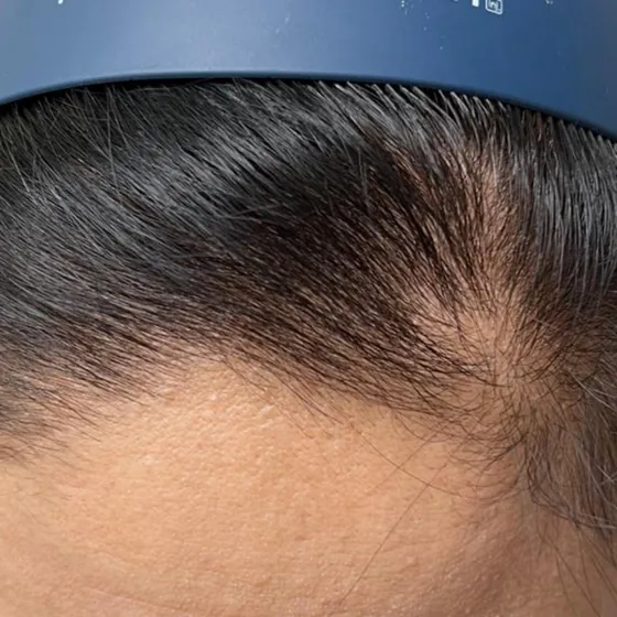 CeraXosome scalp program clinical case, woman aged 53, 5 sessions — after 10 weeks