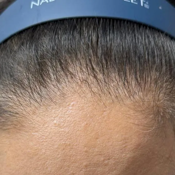 CeraXosome scalp program clinical case, woman aged 53, 5 sessions — baseline