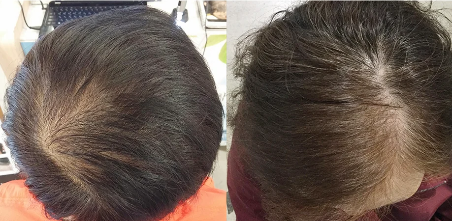 Close-up photos of the scalp at the crown