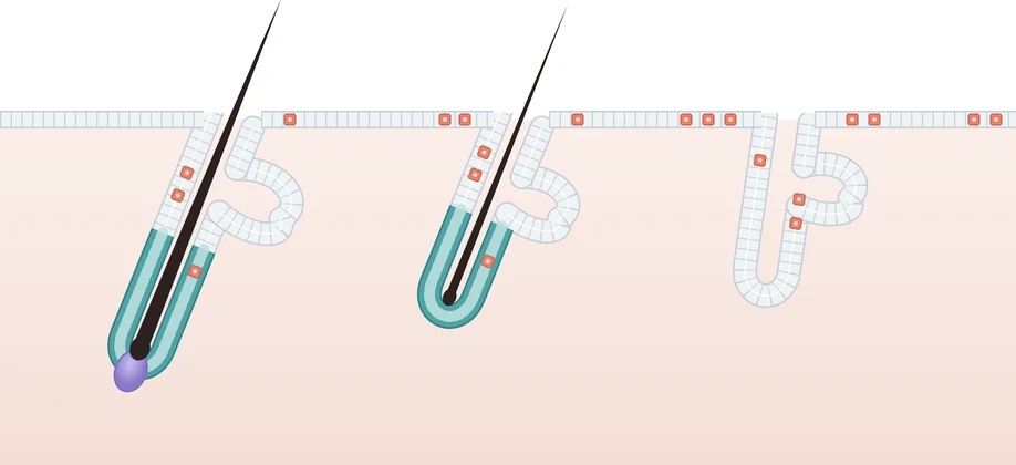 Illustration of hair follicles: healthy, thinning, and hair loss