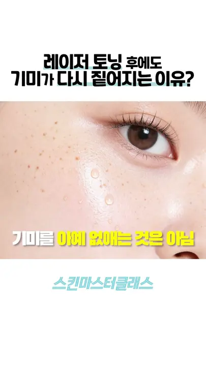 Melasma came back after laser — why?