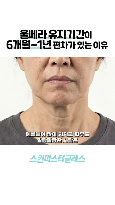 How long does Ultherapy last?